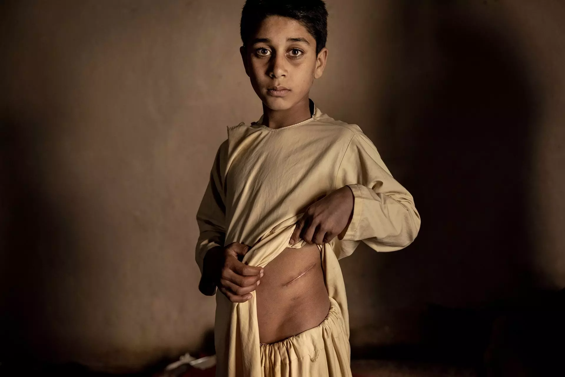 Menino mostra cicatriz Foto de guerra conflito Afeganistão fotojornalismo World Press Photo 