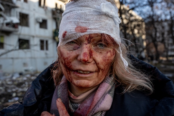 Mulher com rosto coberto de sangue após bombardeio na guerra da Ucrânia