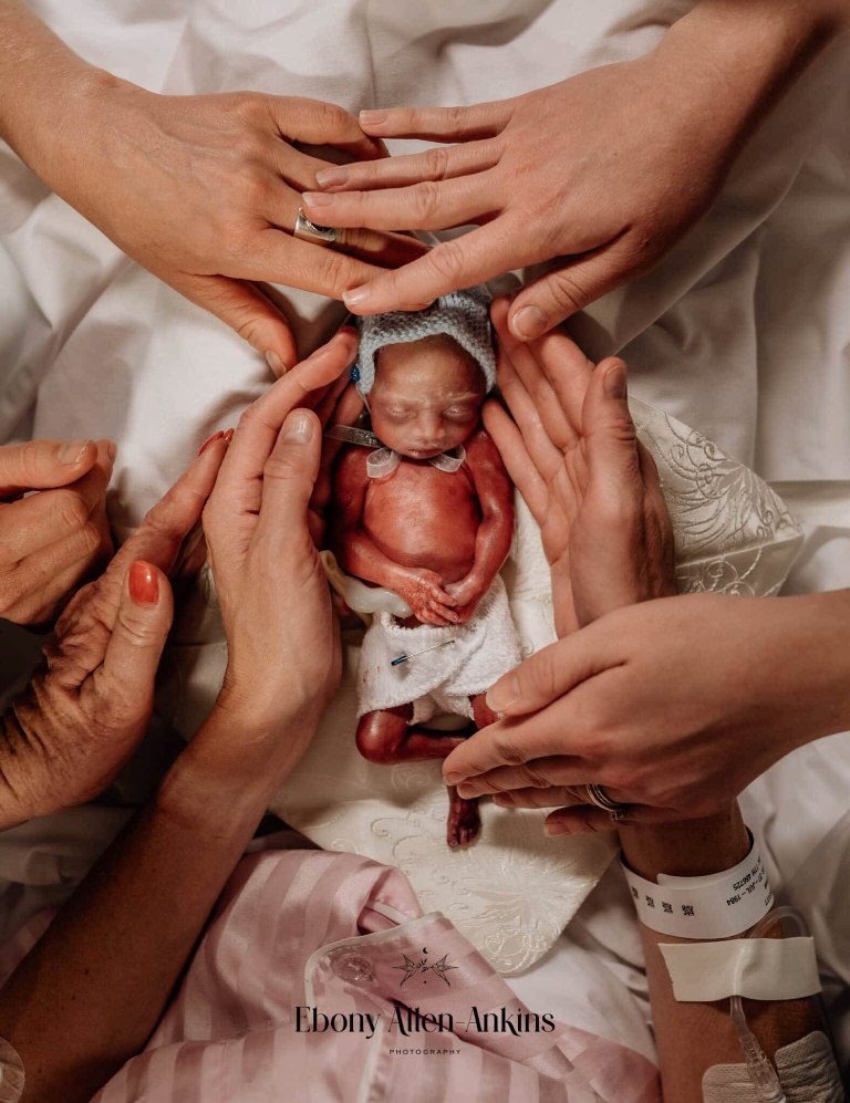 bebê prematuro cercado por mãos fotos de parto nascimento