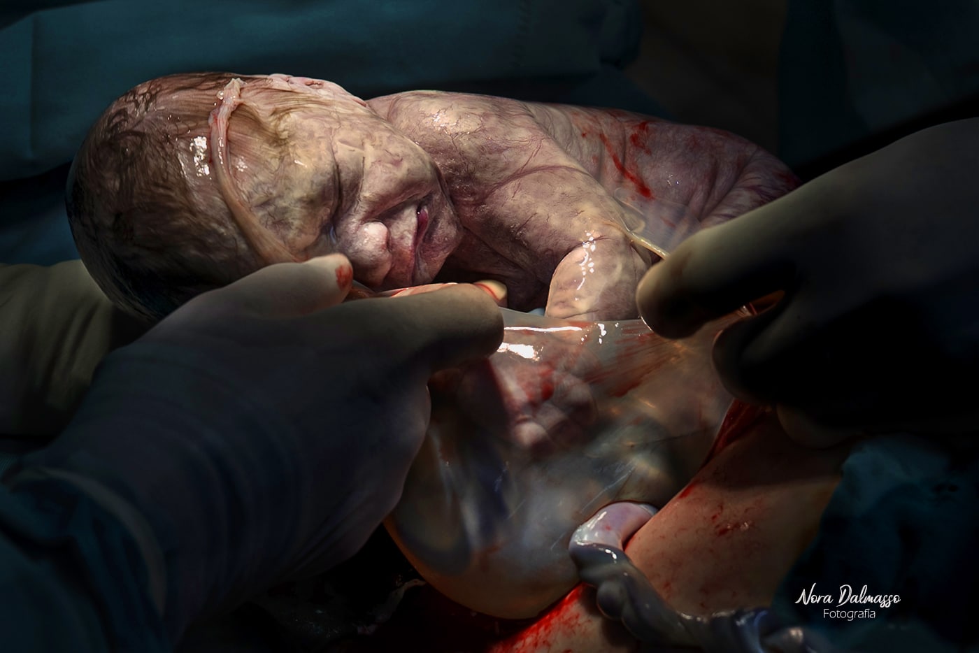 bebê nascendo fotos de parto nascimento