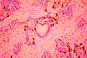 Foto de células de câncer de mama fica em terceiro lugar de concurso de mficrofotografia